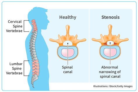 Cervical Spinal Stenosis - Symptoms, Causes, Treatments Health Healthy, Back Pain, Health