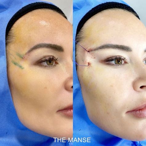 #plasticsurgery #plasticsurgerygonewrong #beforeafter #celebritiesbeforeafter #hollywoodstars #bignosesurgery #surgery #facesurgery #vlinesurgery #koreanplasticsurgery #kpopplasticsurgery #nosejob #jawreductionsurgery #eyesurgery #cheekfillers #rhinoplasty #facelift #plasticsurgeryfails #expensiveplasticsurgery #viral Eye Thread Lift, Eye Lift Surgery, Thread Lift Face, Jaw Reduction Surgery, Botox Brow Lift, Plastic Surgery Fail, Plastic Surgery Gone Wrong, Face Surgery, Eyebrow Lift