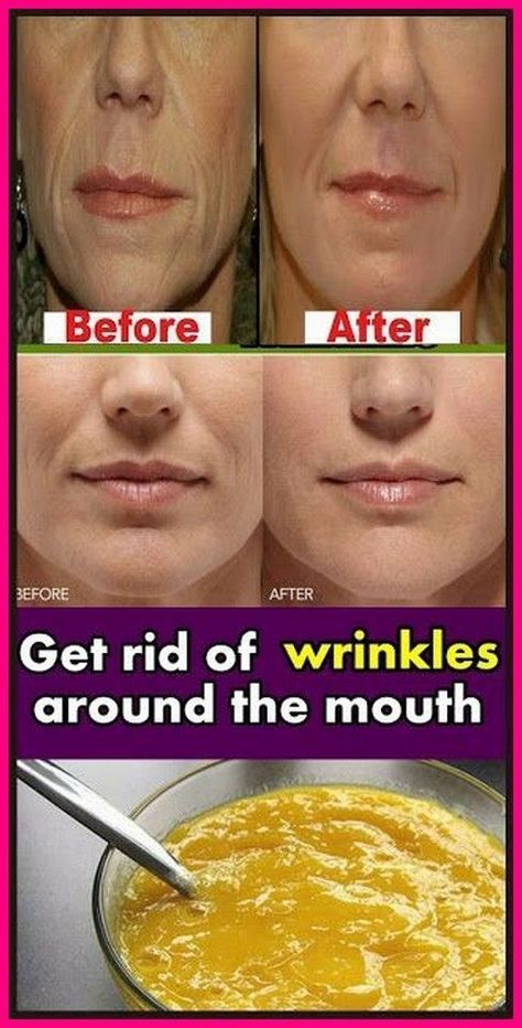 Mouth Wrinkles, Get Rid Of Wrinkles, Skin Care Routine For 20s, Skin Care Wrinkles, Baking Soda Shampoo, Face Wrinkles, Wrinkled Skin, Unwanted Hair Removal, Deep Wrinkles