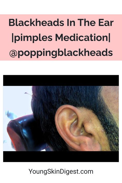 Blackheads In The Ear |pimples Medication| @poppingblackheads Ear Blackheads, Black Head Removal Video Nose, Pimple Hacks, Huge Blackheads, Acne Recipes, Ear Pimple, Pimple Causes, Blind Pimple, Clear Blackheads