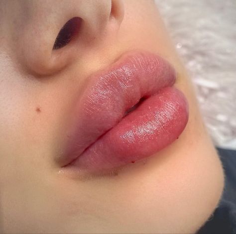 Lips Inspiration, Botox Lips, Facial Fillers, Facial Aesthetics, Women Lipstick, Lip Injections, Perfect Lips, Nose Job, Hot Lips