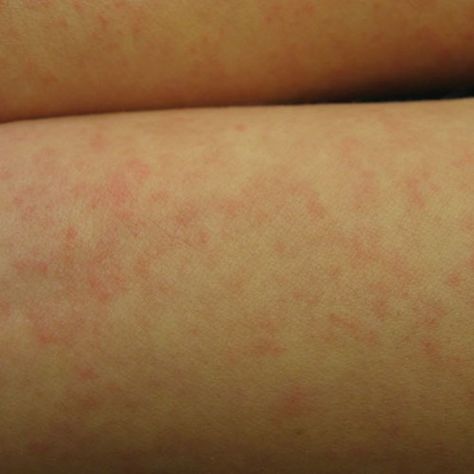 How to Identify Hives vs. Other Skin Rashes: Hives Caused by Infection Skin Rashes Pictures, Hives Causes, Hives Rash, Leg Rash, Types Of Skin Rashes, Allergy Rash, Rashes Remedies, Types Of Rashes, Rash Causes