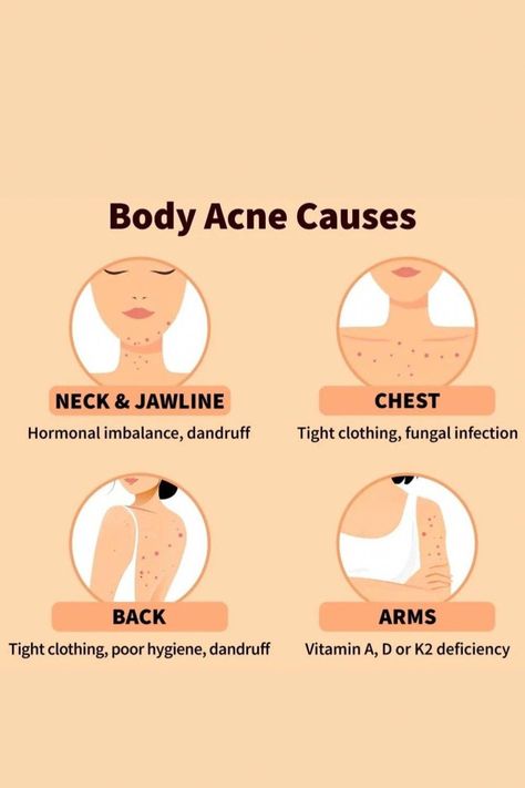 Bad Acne, Skin Advice, Acne Skincare, Natural Face Skin Care, Natural Acne Remedies, Types Of Acne, Acne Causes, Body Acne, Basic Skin Care Routine