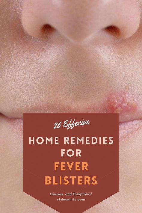 Fever blisters or cold sores are a highly contagious condition that is painful and unsightly. Scroll down this article for some home remedies to treat cold sores. Fever Blister Causes, Fever Blister Remedy, Remedies For Fever, Blister Remedies, Lemon Balm Oil, Canker Sore Remedy, Home Remedies For Fever, Fever Blister, Cold Sores