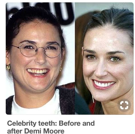 Celebrity Teeth, Teeth Correction, Facial Warts, Celebrity Smiles, Veneers Teeth, Bad Teeth, Laser Teeth Whitening, Celebrities Then And Now, Celebrities Before And After