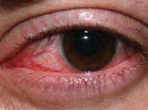 Keratitis Dry Eye Symptoms, Bloodshot Eyes, Dry Cracked Lips, Swollen Eyes, Irritated Eye, Eye Infections, Sore Eyes, Healthy Eyes, Eyes Problems