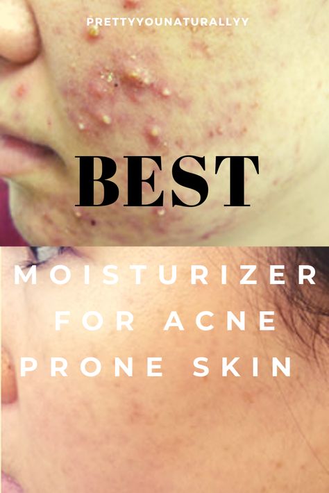 #acnetreatment #acneremedies #skincareroutine #skincareproducts #moisturizer #moisturizingfacecream #acnesecrets Best Moisturizer For Acne Prone Skin, Moisturizer For Acne Prone Skin, African Tribe, Acne Moisturizer, Severe Acne, Skincare Routines, Genetic Disorders, Moisturizing Face Cream, Oil Free Moisturizers