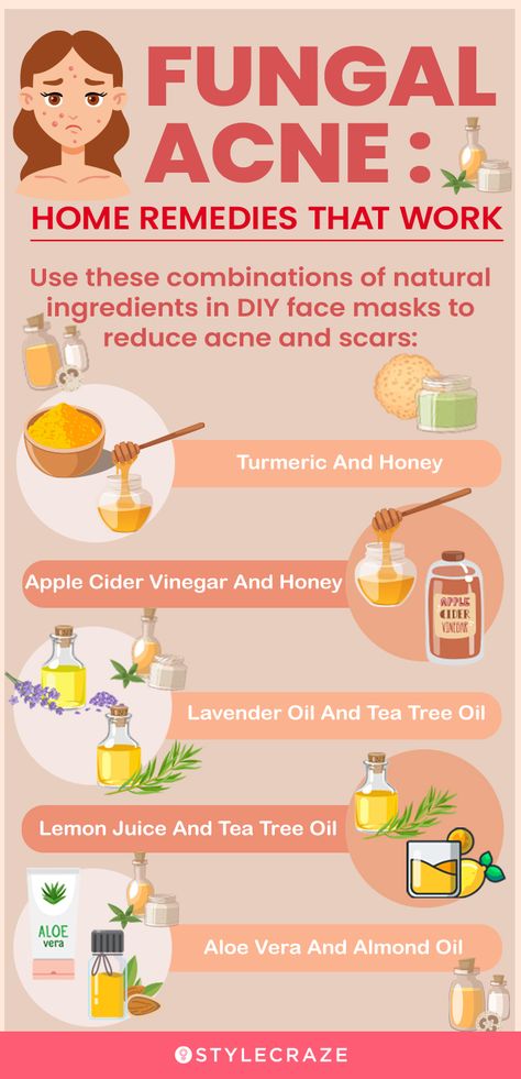 Back Acne Remedies, Blind Pimple, Fungal Acne, Turmeric And Honey, Acne Overnight, Acne Vulgaris, Diy Acne, Natural Acne Remedies, Natural Acne