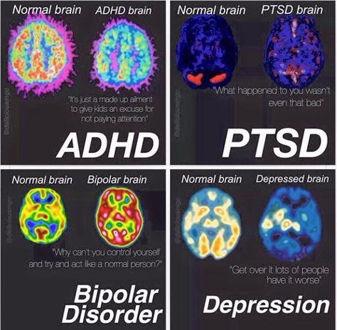 Yes, it is all in my head!!! Mental Health is still a disease even if you cannot see it! Did Mental, Mentally Ill Character, Vent Notes, Mental Diseases, Mental Disabilities, My Mental State, Brain Images, Mental Health Facts, Medical School Studying