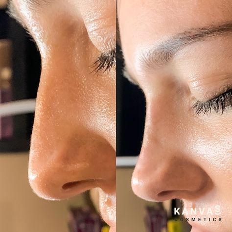 Double tap if you love a pixie lift 🧚 Who *wouldn't* want that cute, pointed nose and the appearance of a slim bridge? 🙋🏻‍♀️🙋🏼‍♀️🙋🏽‍♀️🙋🏾‍♀️🙋🏿‍♀️ You can get the nose of your dreams with us for only £299—head over to our DMs before we're fully booked for November and December! 💙 Bump On Nose Bridge, Bump Nose Bridge, Tinker Bell Nose Job, Tinkerbell Tip Lift Nose, Nose Tip Lift, Pointed Nose, Pretty Features, Fully Booked, Upper Lip