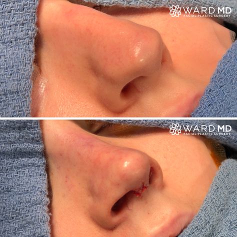 Bulbous Tip Rhinoplasty Before After, Bulbous Nose Before And After, Nose Job Tip Reduction, Tip Rhinoplasty Before After, Rhinoplasty Bulbous Tip, High Radix Nose, Nose Rhinoplasty Before After, Bulbous Nose Job, Nose Job Bulbous Tip