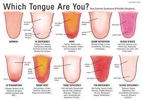 There are many warning signs your tongue may be sending you about your health, so grab a mirror, open wide and discover what your tongue is trying to tell you. If you recognize any of these symptoms, check with your doctor or dentist to get a proper diagnosis. Tongue Health, Body Hacks, Alternative Health, Health Info, Chinese Medicine, Natural Medicine, Alternative Medicine, Acupuncture, Health Remedies