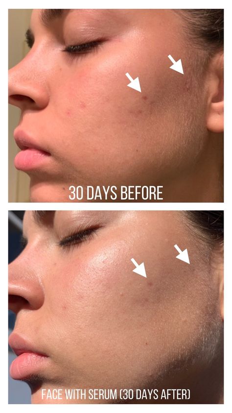 The Ordinary Niacinamide Before After, The Ordinary Niacinamide 10% + Zinc 1% Before And After, Ordinary Niacinamide Before After, The Ordinary Niacinamide 10% + Zinc 1%, Niacinamide Before And After, The Ordinary Before And After, Before And After Skincare, The Ordinary Peeling Solution, Glowing Skin Overnight