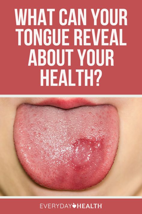 Your tongue does a lot more than taste. It’s even part of your immune system. Black Tongue Smooth Tongue White Patches on Tongue White or Red Spots or Lesions Yellow Tongue The color, texture, and coating of the tongue can provide clues about what’s going on with your health. Lingual Tonsils, Yellow Tongue, Tongue Sores, Homemade Facial, Black Tongue, Tongue Health, White Patches, The Tongue, Oral Health Care