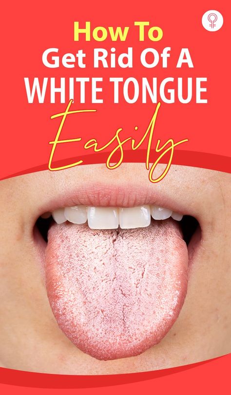 Sore Tongue Remedy, Mouth Sore Remedy How To Get Rid, Dry Mouth Remedies How To Get Rid, Dry Mouth Remedies, Get Rid Of Candida, Remedies For Dry Mouth, White Tongue, Mouth Health, Healthy Mouth