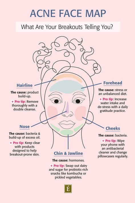 Acne Face Map, Face Map, Face Mapping Acne, Forehead Acne, Eminence Organic Skin Care, Skin Advice, Face Mapping, Acne Face, Natural Acne Remedies