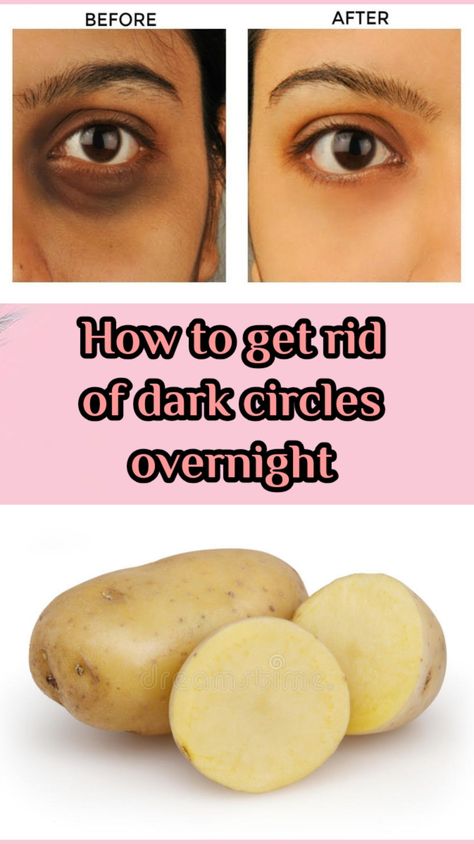 Get Rid of Dark Circles at Home Potato For Dark Circles, Dark Circle Remedies Overnight, Gallbladder Removal, Dark Circle Remedies, Dark Circles Around Eyes, Brown Spots On Skin, Wrinkle Remedies, Dark Eye Circles, Brown Spots Removal