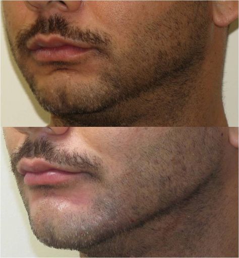 Before/after chin and jaw augmentation with filler (non-surgical). Face is more proportional and masculine. Jawline Men, Neck Lift Surgery, Square Jawline, Chin Filler, Chin Implant, Face Fillers, Lip Balm Tin, Lip Art Makeup, Facial Fillers