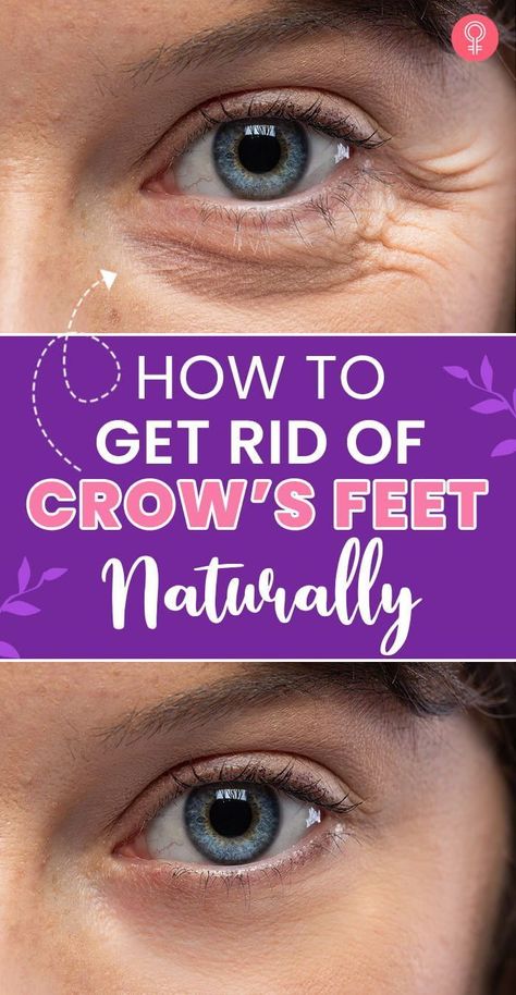 Best Eye Wrinkle Cream Crows Feet Anti Aging, How To Get Rid Of Crows Feet Eye, Crows Feet Remedies, Eye Wrinkles Get Rid Of, Botox Crows Feet Eye, Crows Feet Wrinkles How To Get Rid, Facial Remedies, Crows Feet Wrinkles, Home Remedies For Wrinkles