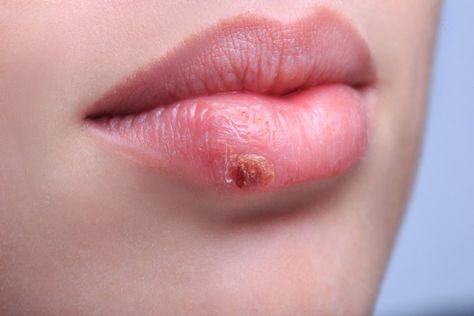 Heal A Cold Sore (Fever Blister) Faster - Simply and Naturally Fever Blister Remedy, Blister On Lip, Canker Sore Remedy, Home Remedies For Fever, Dark Circle Remedies, Fever Blister, Canker Sore, Cold Sores Remedies, Cold Sore