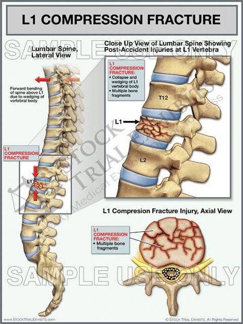 This trial exhibit depicts lumbar spine anatomy with L1 compression fracture of the vertebra, shown in the lateral view with a close up view of injury and injury is also shown in the axial view, with descriptive labels of anatomy and injuries. Spinal Compression, Spine Anatomy, Lumbar Spine, Spinal Injury, Accident Injury, Dry Skin Remedies, Medical Knowledge, Body Pain, Medical Information