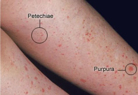 Low Platelet Count Low Platelets, Rare Disorders, Critical Care Nursing, Skin Spots, Ehlers Danlos Syndrome, Medical Laboratory, Rare Disease, Skin Disorders, Medical Information