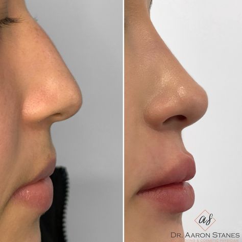 Nose Job Inspiration Straight, Nose Job Side Profile, Closed Rhinoplasty, Side Nose Profile, Front Nose Profile, Best Noses, Cute Nose Front View, Turkish Rhinoplasty, Side Photo