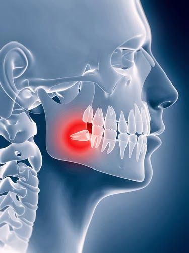 Wisdom Teeth Swelling, Impacted Wisdom Teeth, Wisdom Teeth Pain, Tooth Extraction Aftercare, Bone Infection, Tooth Extraction Healing, Impacted Tooth, Teeth Illustration, Wisdom Tooth Extraction