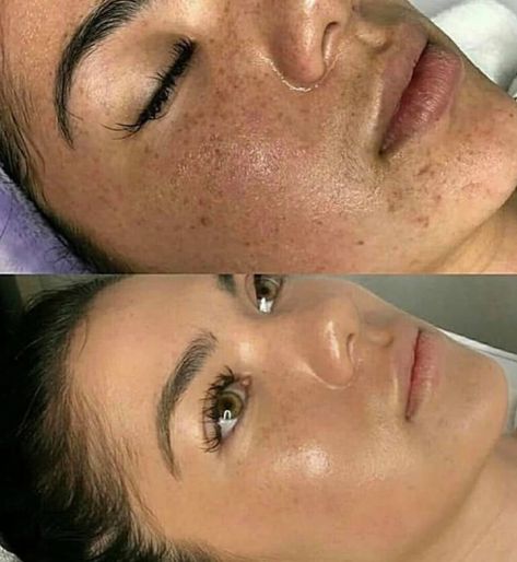 BB Glow - Your answer to a sunkissed look without having to damage your skin #bbglow #sunkissedskin #tannedskin #semipermenantfoundation #beyoutifultraining Facial Before And After, Poreless Skin, Botox Lips, Bb Glow, Sunkissed Skin, Botox Fillers, Uneven Skin Texture, Skin Care Spa, Facial Spa