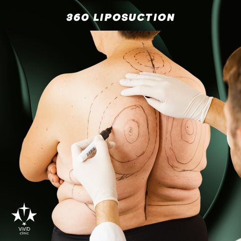 💥 Achieve a complete body transformation with 360 Liposuction at Vivid Clinic! This advanced procedure targets stubborn fat around your waist, abdomen, back, and sides for a balanced, sculpted look from every angle. 🔥 ✅ Comprehensive fat removal for a toned, slim physique ✅ Ideal for stubborn areas resistant to diet and exercise ✅ Quick recovery with long-lasting results 💬 Ready to reshape your body? Book your free consultation today and get started on your transformation! 📍Located in Ista... Diet And Exercise, The Body Book, Fat Removal, Stubborn Fat, Transformation Body, Free Consultation, Get Started, Long Lasting, Diet