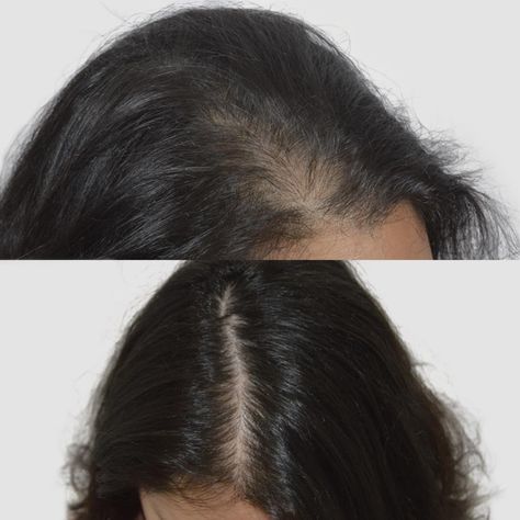 Female Gallery — Advanced Hair Restoration Hair Before And After, Female Hair Transplant, Hair Transplant Women, Arrow Image, Scalp Micropigmentation, Scalp Brushing, Female Hair, Photo Restoration, Women Health