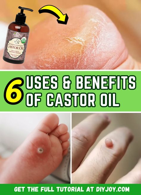 Castor Oil For Hemmoroids, Castor Oil Skin, Castor Oil Benefits Skin, Castor Oil Pack Benefits, Benefits Of Castor Oil, Castrol Oil, Castor Oil Uses, Castor Oil For Skin, Castor Oil Benefits