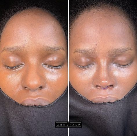 Nose Plastic Surgery, Ethnic Rhinoplasty, Rhinoplasty Nose Jobs, Face Surgery, Wide Nose, Pretty Nose, Beauty Procedures, Beautiful Freckles, Perfect Nose