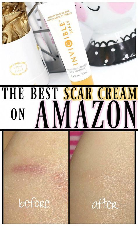 #HomeRemediesToCureCold Best Scar Cream, Scar Remedies, Scar Cream, Skin Natural Remedies, Cold Sores Remedies, Acne Scar Removal, Natural Sleep Remedies, Natural Cold Remedies, Natural Cough Remedies