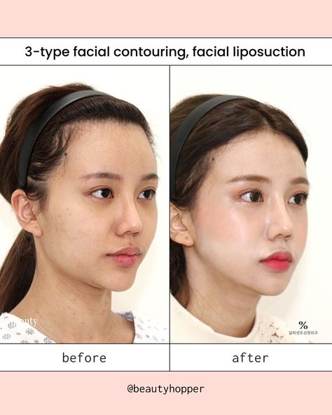 Facial contouring surgery can help create a more balanced and attractive look by reshaping the bones in your face 🧚‍♀️  Common procedures include cheekbone reduction, jaw reduction, & chin reshaping. These will be customised to your specific needs and combined for the best results👍🏻 Although the recovery period to see full results can be lengthy, many patients find the permanent results well worth it✨ Let us help you plan a safe and successful plastic surgery trip to Korea  ❤️ For all inqu... Chin Reduction Surgery, Facial Contouring Surgery, Cheekbone Reduction, Chin Surgery, Jaw Reduction Surgery, Botox Injection Sites, Chin Reduction, Trip To Korea, Plastic Surgery Korea