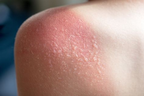 Sun Blisters, Sun Poisoning, Sunburn Blisters, Blister Remedies, How To Heal Blisters, Severe Sunburn, How To Treat Sunburn, Skin Blisters, Sunburn Peeling