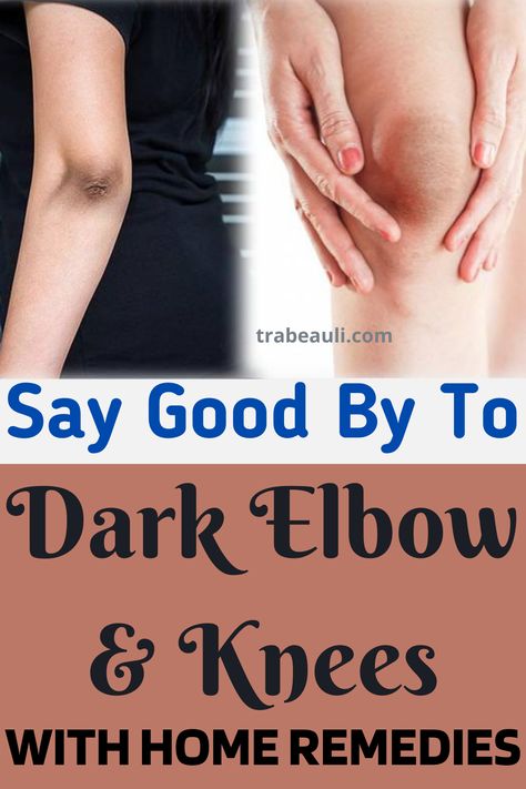 Some amazing home remedies for black elbow and knees to get rid of dark elbows overnight. These remedies daily or even alternate days use and you will find a great change in your knee and elbow skin. Check out the blog- #darkknees #darkelbows #homeremedies #elbowandknees #removeblackelbow How To Lighten Knees, Sagging Cheeks, Dry Elbows, Dark Elbows, Dark Underarms, Dark Spots On Skin, Saggy Skin, Dewy Skin, Remove Acne