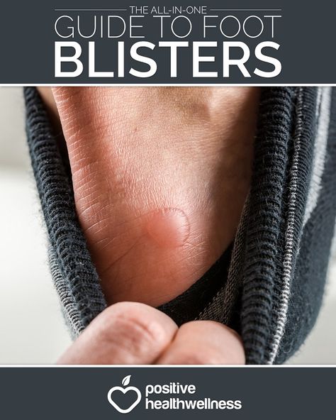 The All-In-One Guide To Foot Blisters - Positive Health Wellness How To Get Rid Of Blisters On Feet Fast, How To Heal Blisters On Feet Fast, Blisters Remedies, Essential Oils For Blisters, How To Treat Blisters, Heal Blisters, Water Blister, Blister Remedies, How To Heal Blisters