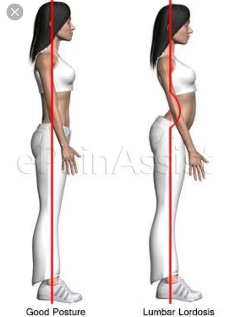 Ask urself...is she thick, or is she suffering from lumbar lordosis? Lumbar Lordosis, Corrective Exercises, Human Spine, Posture Exercises, Better Posture, Back Exercises, Sciatica, Massage Therapy, Physical Therapy