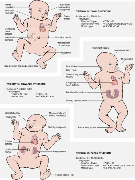 Trisomy 13, Patau Syndrome; Trisomy 18, Edwards Syndrome; Trisomy 21, Down Syndrome Nicu Nurse Education, Newborn Assessment, Neonatal Nurse Practitioner, Newborn Nursing, Diagnostic Medical Sonography, Neonatal Nurse, Nursing School Survival, Nursing School Studying, Nursing School Tips