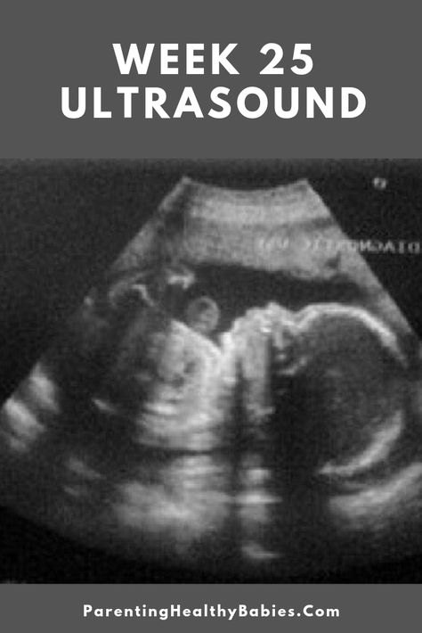 #week25pregnancy #ultrasound #ultrasoundat25weeks 12 Weeks Pregnant Ultrasound, 17 Weeks Pregnant Ultrasound, Baby Ultrasound Pictures, 2weeks Pregnant Ultrasound, 8 Weeks Pregnant Ultrasound, 6 Weeks Pregnant Ultrasound, 25 Weeks Pregnant, Pregnancy Ultrasound, Baby Ultrasound