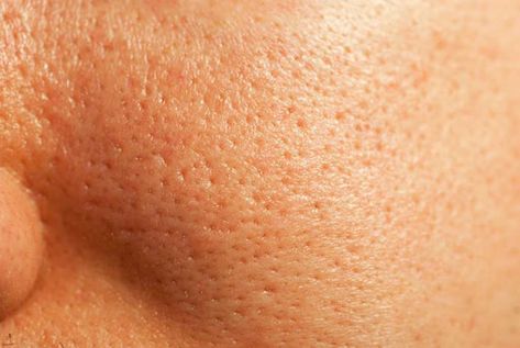 How To Close Pores, Open Pores On Face, Get Rid Of Pores, Dilated Pores, Big Pores, Nose Pores, Face Pores, Eminence Organic Skin Care, Open Pores