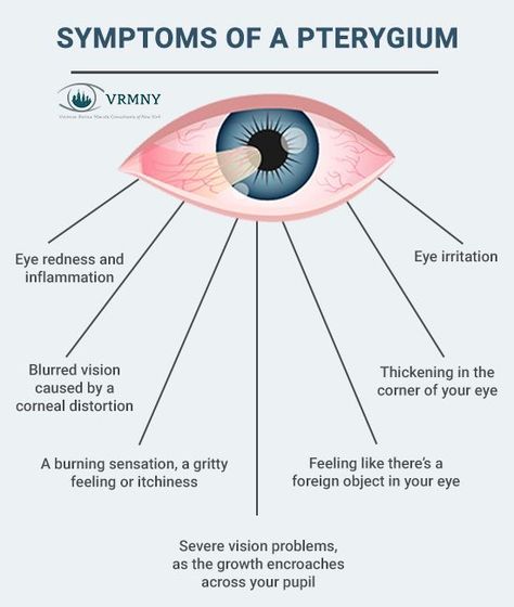 Tip on How to Get rid of a Stye Overnight Opthalmic Technician, Optician Training, Optometry Education, Eye Medicine, Eye Anatomy, Eye Facts, Eye Problems, Vision Eye, Vision Problems