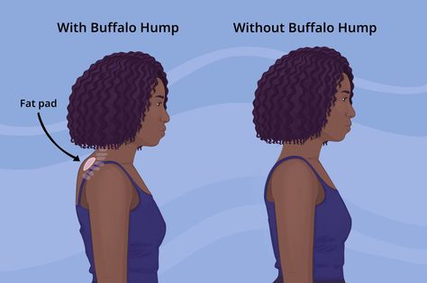 Discover the causes, prevention techniques, and effective solutions to alleviate the discomfort and pain associated with neck hump. - #buffalohump #cervicalhump #cervicalhyperlordosis #dowager'shump #excessivecurvatureoftheupperspine #Forwardheadposture #kyphosis #neckhump #poorposture #Roundedshoulders Back Hump, Dowager's Hump, Neck Hump, Cushings Syndrome, Muscle Stretches, Forward Head Posture, Types Of Surgery, Metabolic Disorders, Muscle Imbalance