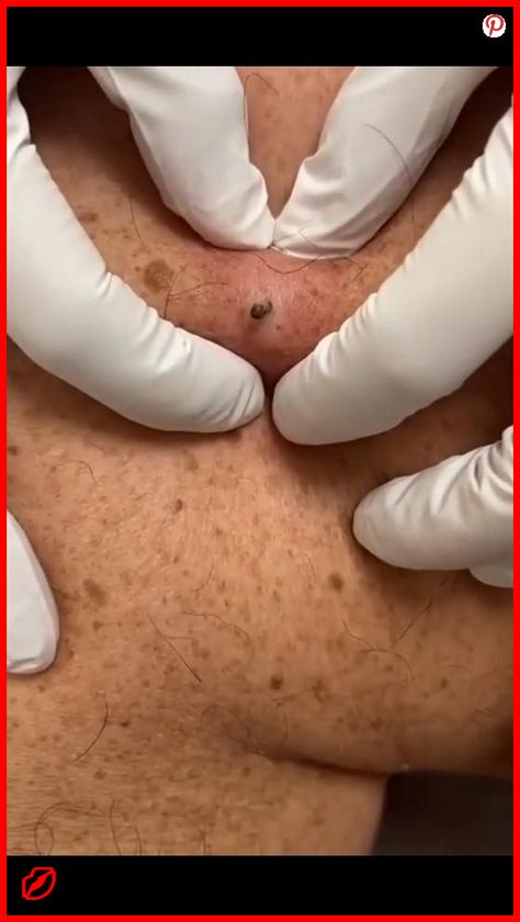 📌 Perfect Skin – The Comprehensive Solution for All Your Needs! zits popping, squeezing pimples, blackheads popping videos faces #PimplePatch #beautyroutine #zits #glowingskin Squeezing Blackheads, Pimple Causes, Remove Blackheads From Nose, Best Dark Spot Corrector, Deep Clean Skin, Blackhead Remedies, Zit Popping Videos, Zits Popping, Clean Blackheads