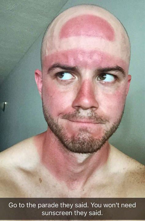 Who Needs A Farmer's Tan When You Can Get A Cavs Finals Hat Burn Funny Sunburn, Sunburn Face, Sunny Day Images, Severe Sunburn, Farmers Tan, Funny Lists, Bad Sunburn, Funny Sun, Red Face