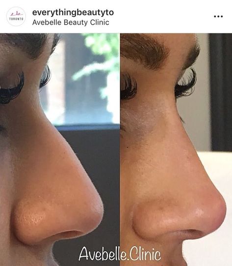 Noses For Nose Jobs, Saddle Nose Deformity, Nose Inspo Rhinoplasty, Nose Tip Filler, Rynoplasty Surgery, Dorsal Hump Rhinoplasty, Turkey Nose Job, Subtle Nose Job, Nose Inspiration Rhinoplasty