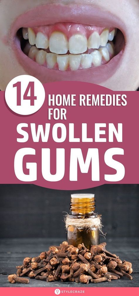 Swollen Gums Remedy, Swelling Remedies, Remedies For Tooth Ache, Gum Inflammation, Swollen Gum, Teeth Health, Gum Care, Receding Gums, Diy Remedies