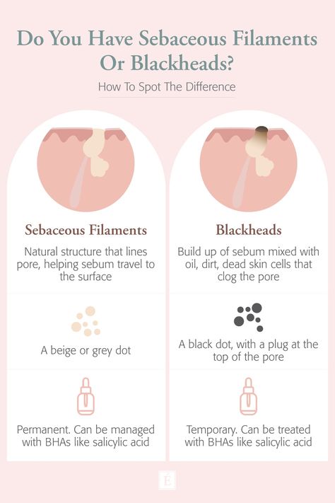 Wondering if you have blackheads? Or are they actually sebaceous filaments? Here's how to spot the difference. #organicskincare #skincaretips #blackheads Sebaceous Filaments, Remove Body Hair Permanently, Prevent Pimples, Eminence Organic Skin Care, Cold Sores Remedies, Spot The Difference, Natural Sleep Remedies, Get Rid Of Blackheads, Natural Cold Remedies