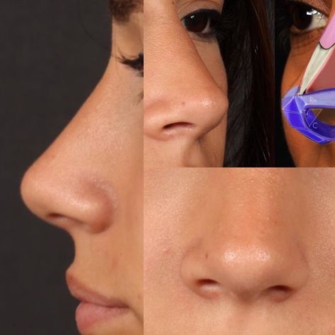 Nose Plastic Surgery, Nose Surgery Rhinoplasty, Nose Jobs, Rhinoplasty Nose Jobs, Nose Reshaping, Job Inspiration, Straight Nose, Pretty Nose, Perfect Nose